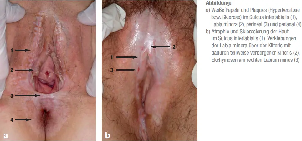 lichen sclerosus schwangerschaft - Welche Lebensmittel bei lichen meiden