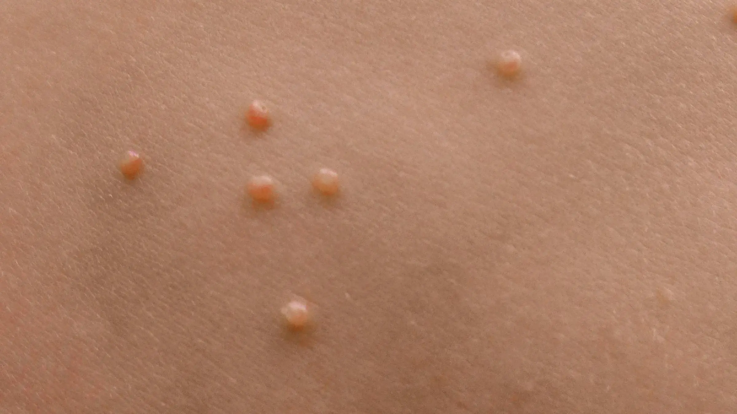 therapie dellwarzen - Welche Medikamente bei Dellwarzen