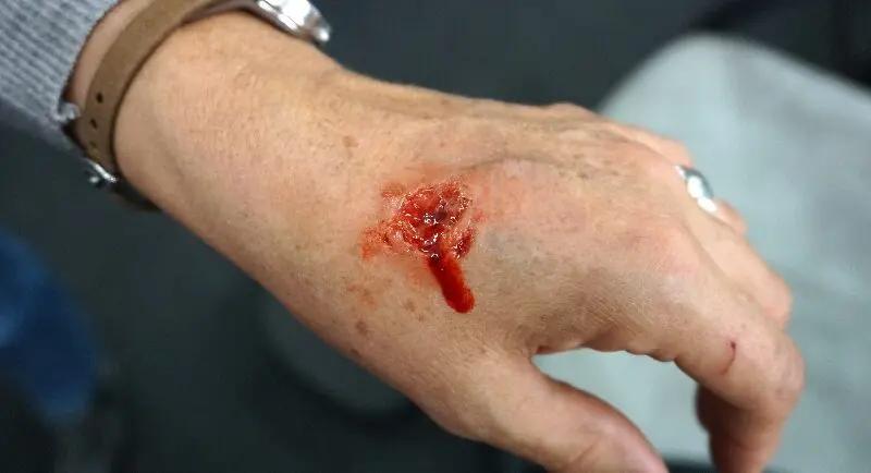blut stillen hausmittel - Welche Möglichkeiten der Blutstillung gibt es