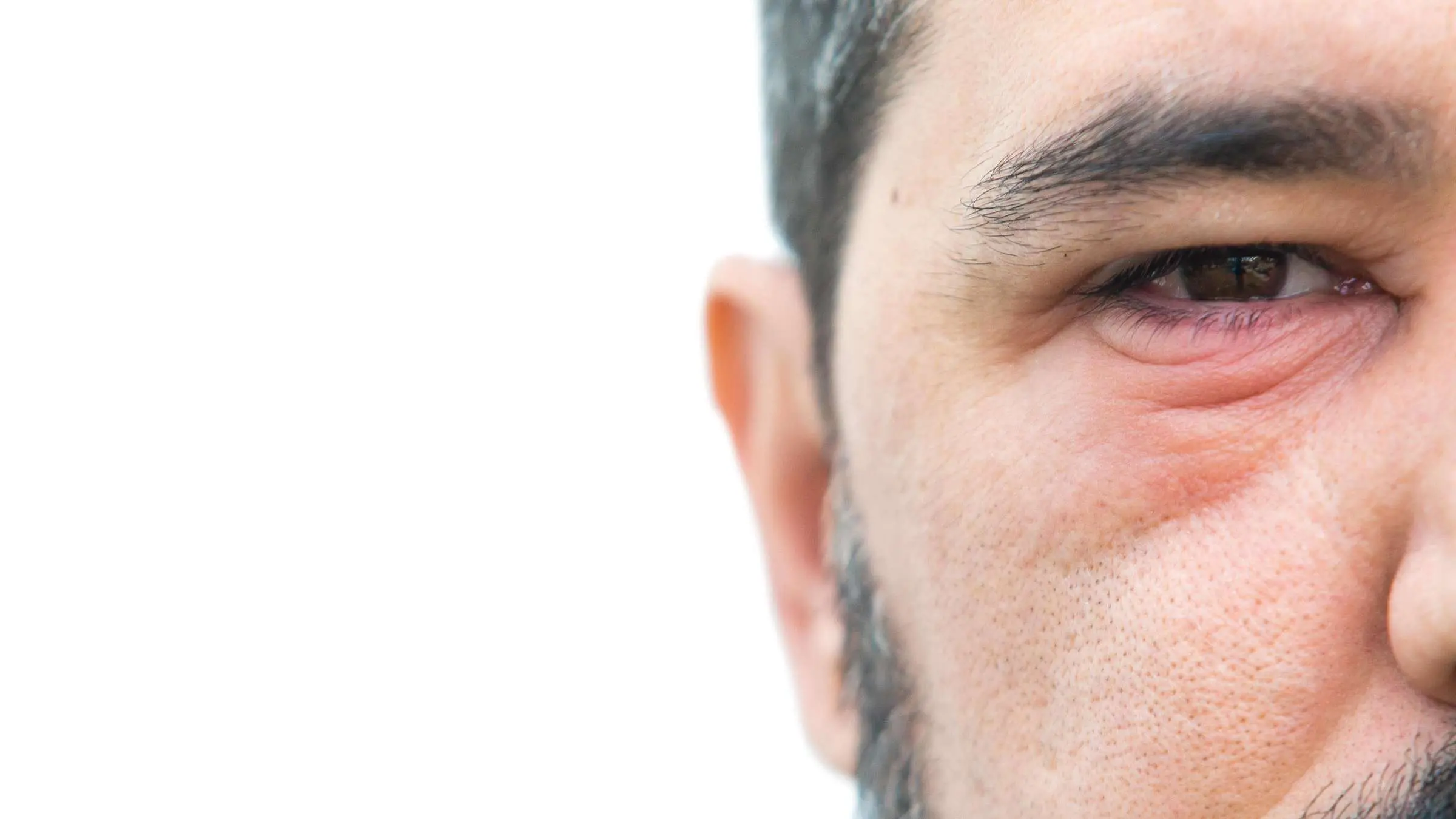 ausschlag unterm auge - Welche Salbe bei Ausschlag am Auge