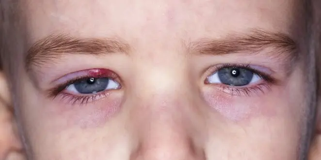 gerstenkorn bei kindern - Welche Salbe bei Gerstenkorn Kind