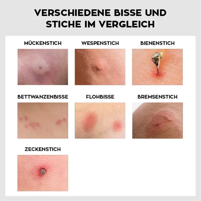 insektenstich bei kindern - Welche Salbe bei Insektenstichen Kinder