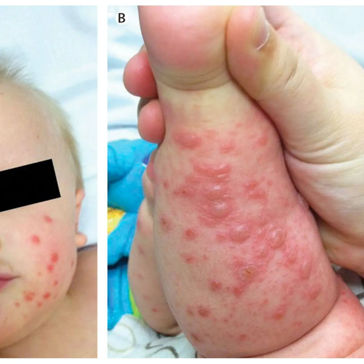 hand-mund-fuß ausschlag am ganzen körper - Welche Salbe hilft bei Hand-Mund-Fuß