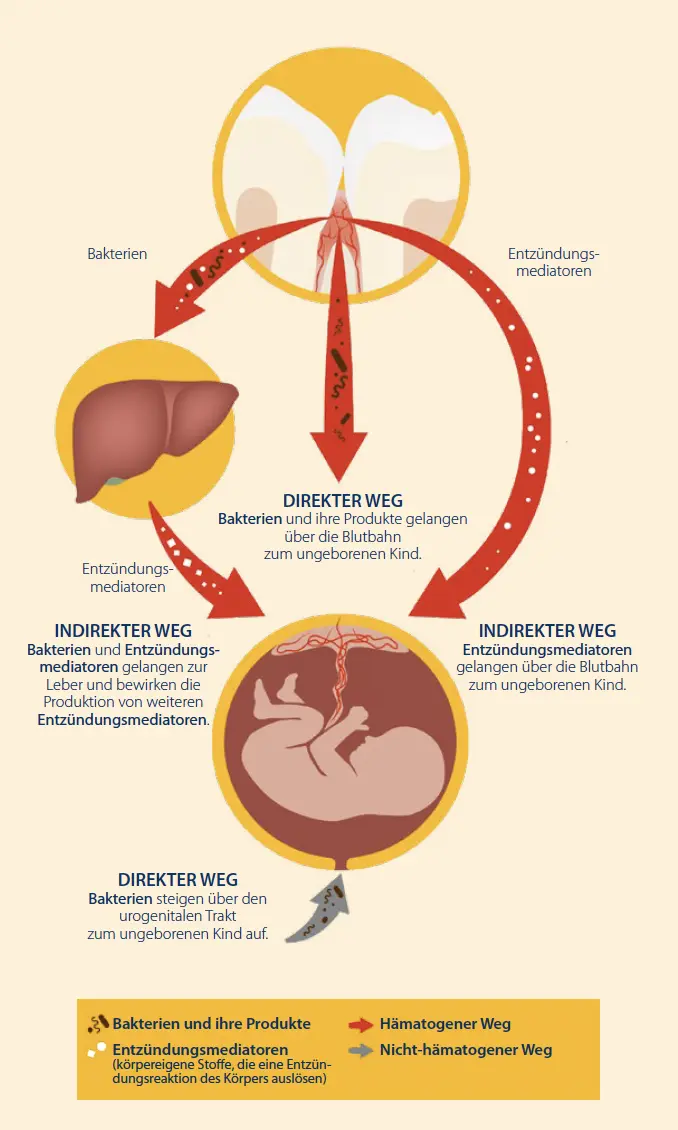 zahnfleischentzündung schwangerschaft salbe - Welche Salbe hilft bei Zahnfleischentzündungen