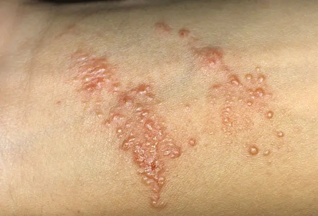 metallvergiftung symptome - Welche Symptome bei Aluminiumvergiftung