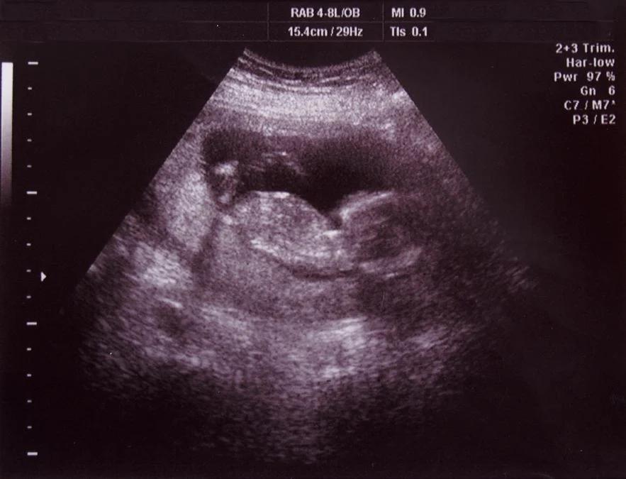 nt messung schwangerschaft - Welcher Wert ist bei der Nackenfaltenmessung normal