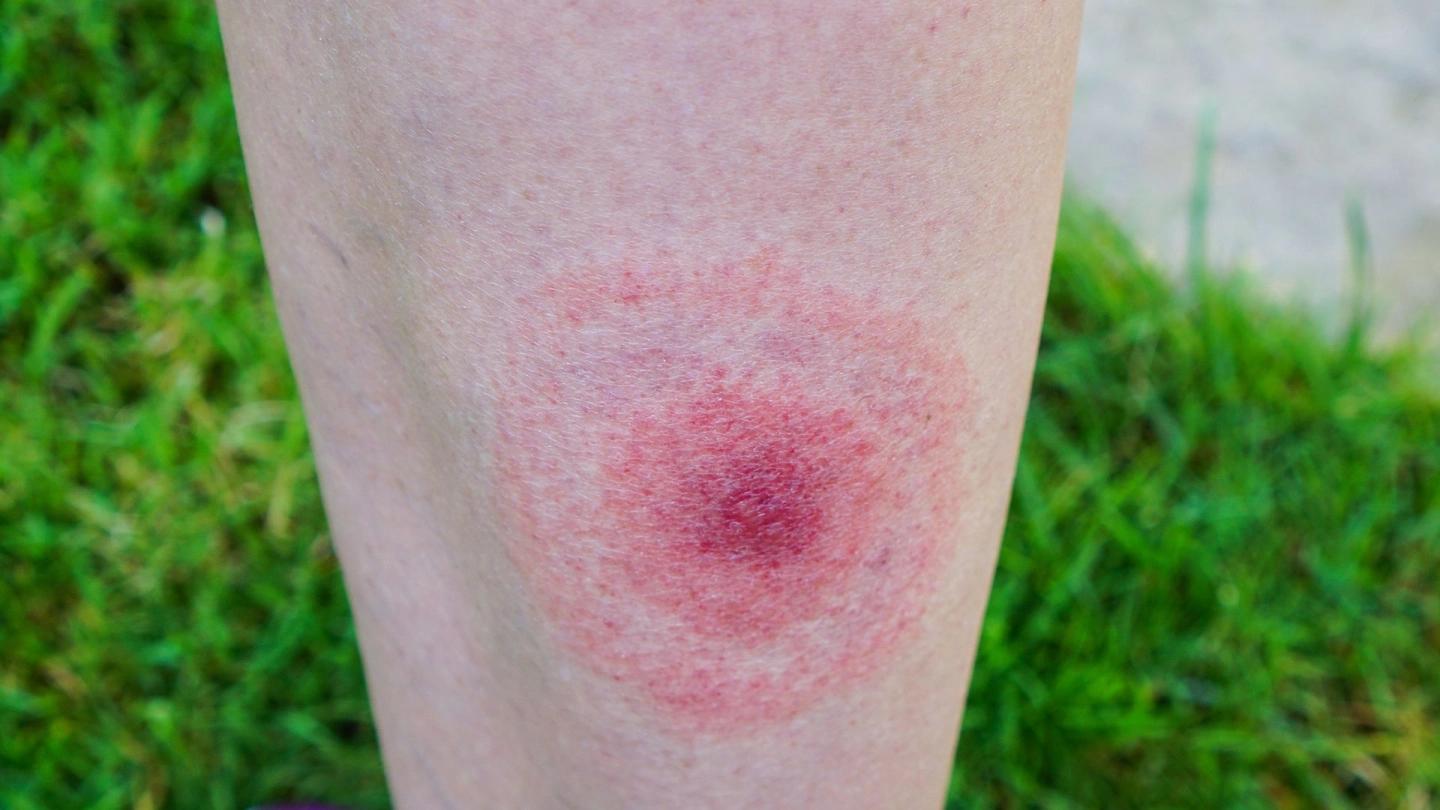 borrelien schwangerschaft - Welches Antibiotikum bei Borreliose in der Schwangerschaft