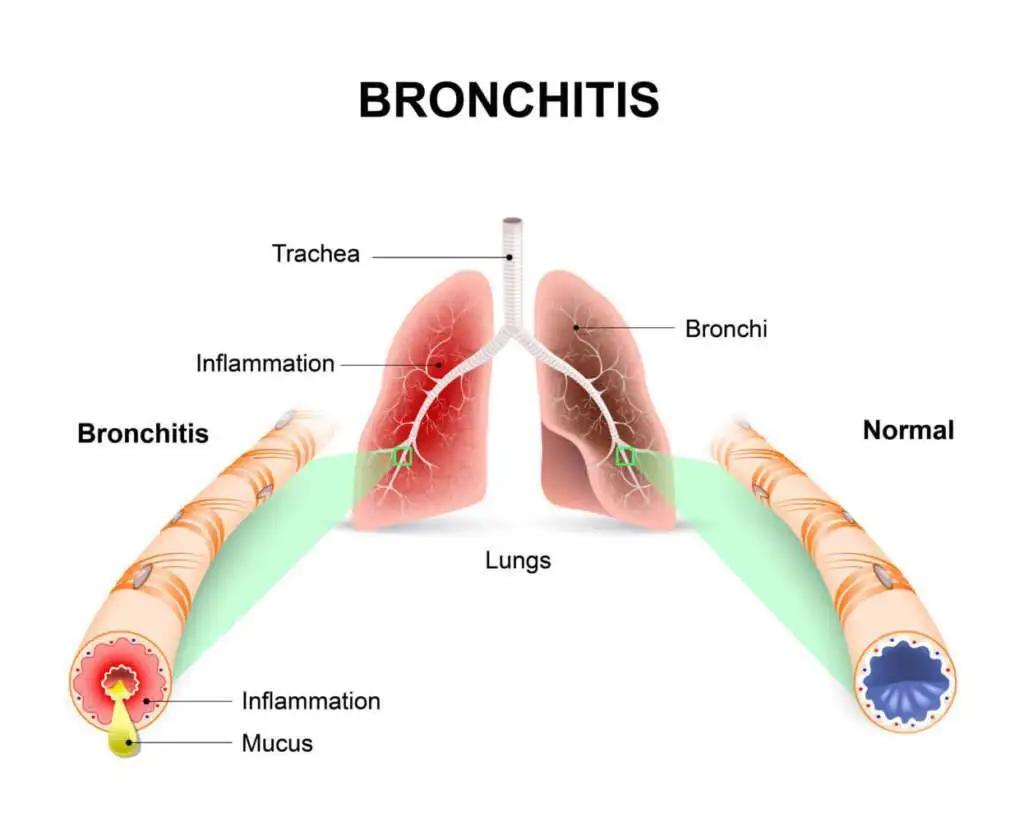 spastische bronchitis - Welches Antibiotikum bei spastischer Bronchitis
