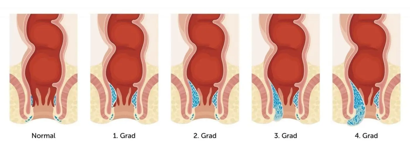 hämorrhoiden nach geburt hausmittel - Welches Hausmittel lässt Hämorrhoiden schrumpfen