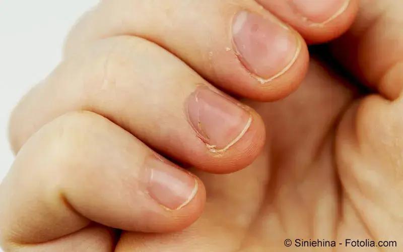 brüchige nägel schwangerschaft - Welches Vitamin fehlt bei brüchigen Nägeln