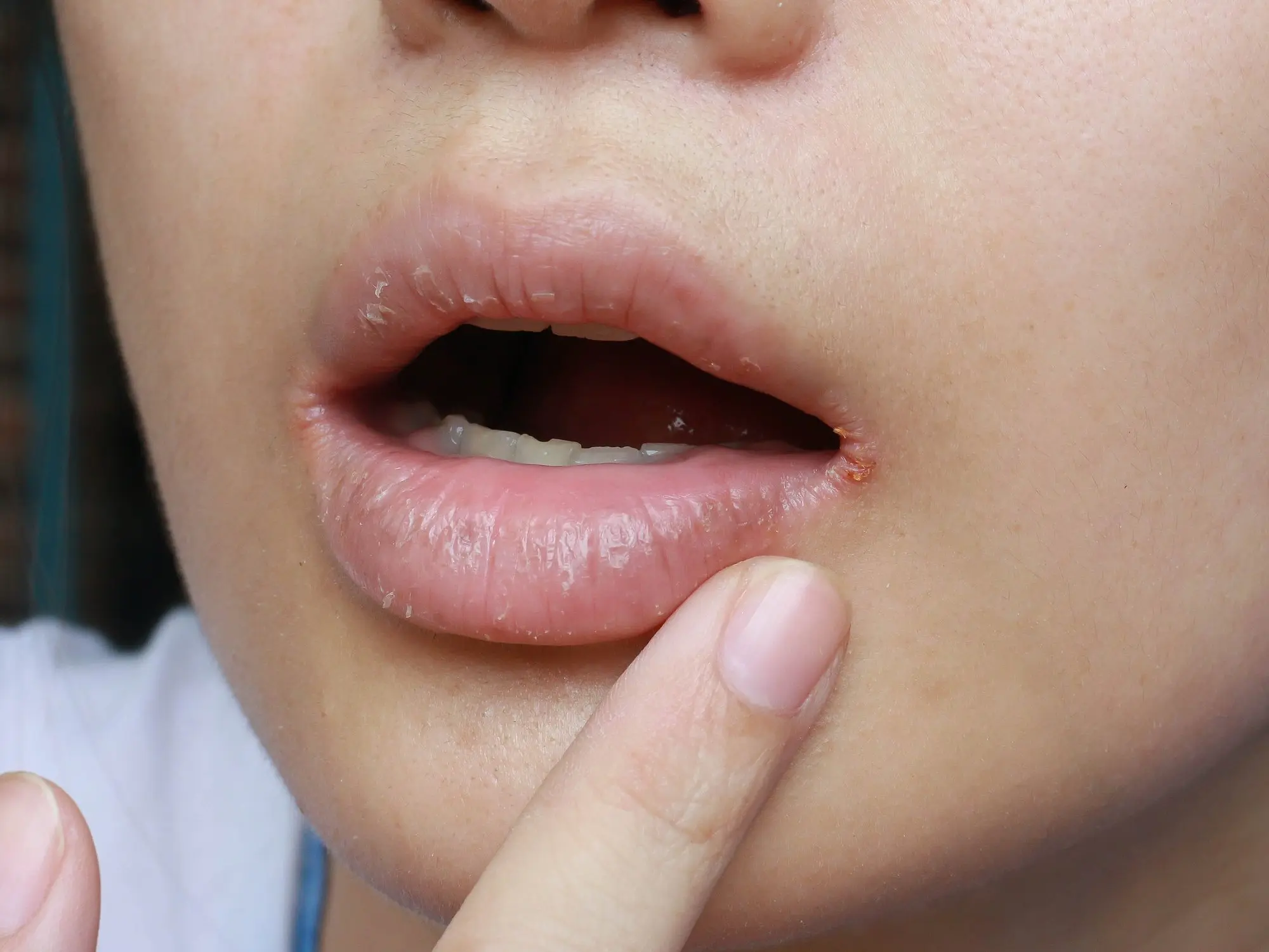 Eingerissene Mundwinkel in der Schwangerschaft: Ursachen, Symptome und Behandlung - Welches Vitamin fehlt bei eingerissenen Mundwinkeln eingerissene mundwinkel schwangerschaft - Welches Vitamin fehlt bei eingerissenen Mundwinkeln