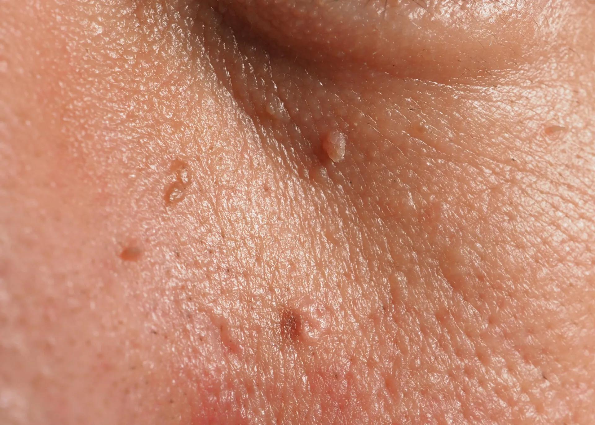 apfelessig warze schwangerschaft - Welches Vitamin fehlt bei Warzen