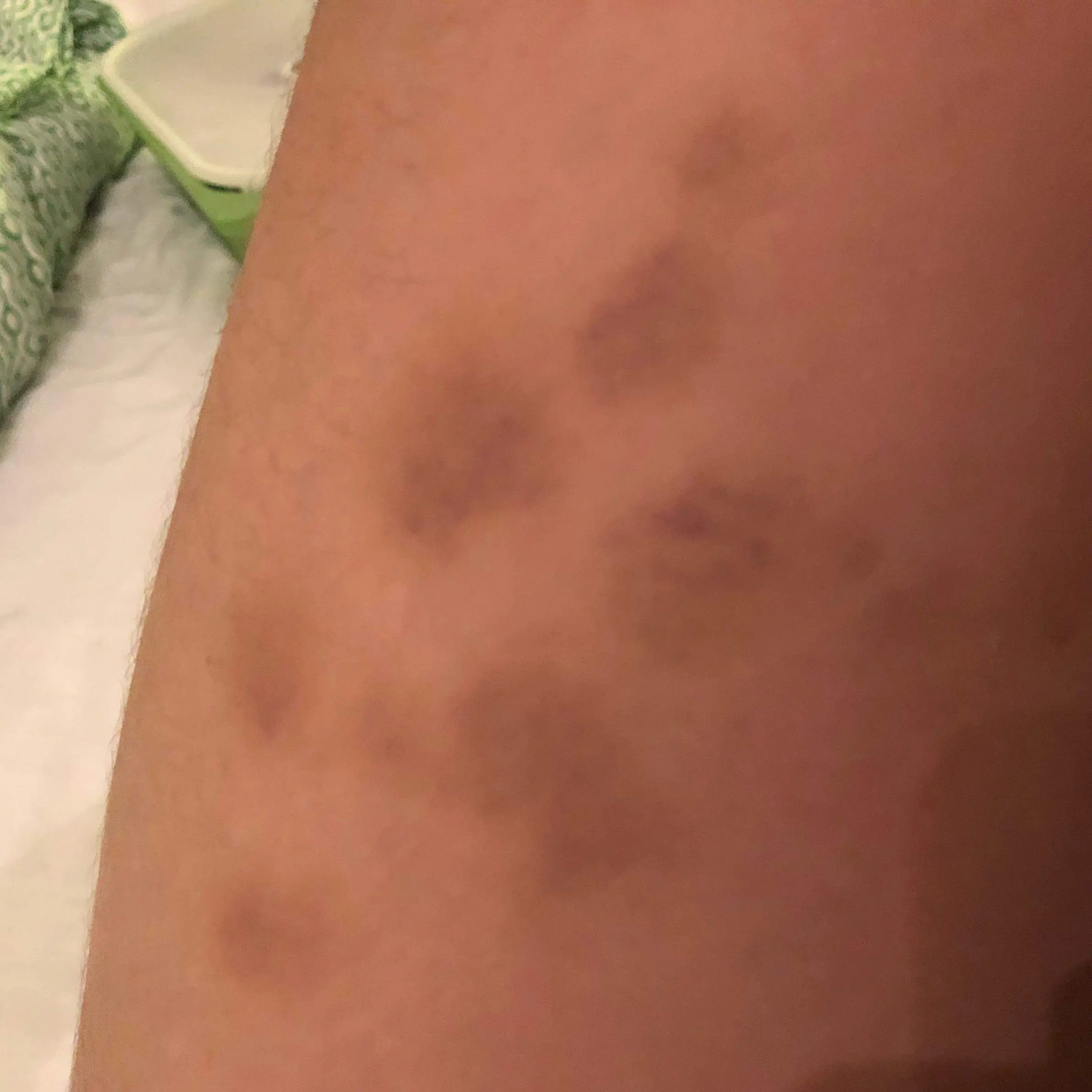 Kleine blaue Flecken am Oberschenkel: Ursachen, Symptome und Behandlung - Welches Vitamin fehlt Wenn man schnell blaue Flecken bekommt kleine blaue flecken am oberschenkel - Welches Vitamin fehlt Wenn man schnell blaue Flecken bekommt