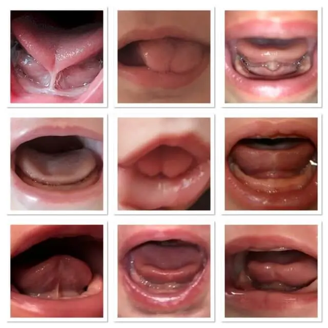 verkürztes zungenbändchen baby - Wer darf Zungenbändchen durchtrennen