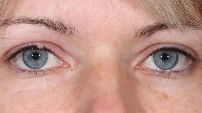 Warzen am Augenlid: Ursachen, Symptome und Behandlung - Wer entfernt eine Warze am Augenlid warze auf dem augenlid - Wer entfernt eine Warze am Augenlid