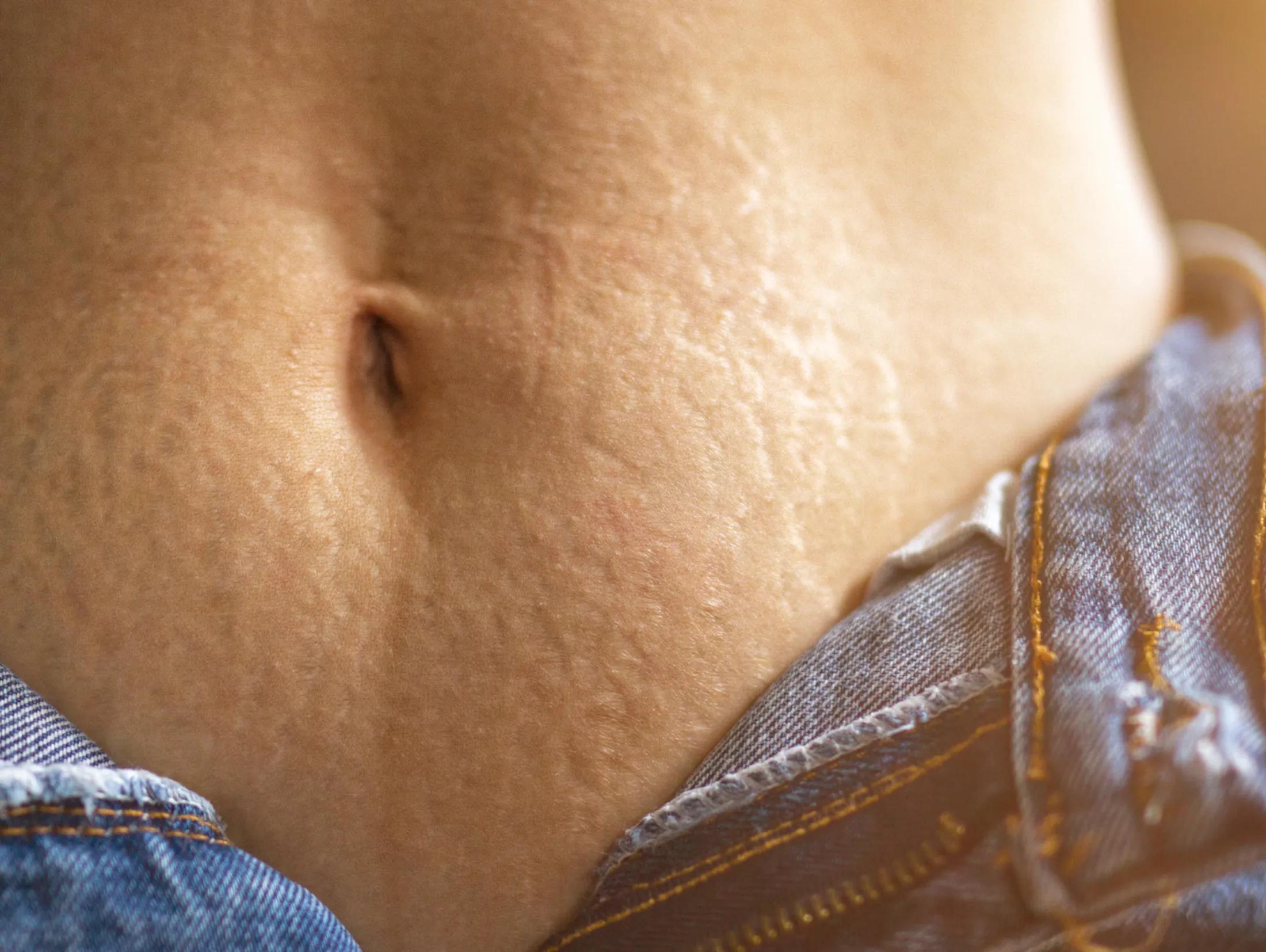 schwangerschaftsstreifen nach geburt bekommen - Wer neigt zu Schwangerschaftsstreifen