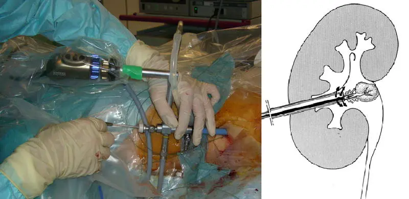 nierenstein-op gefährlich - Werden Nierensteine unter Vollnarkose entfernt