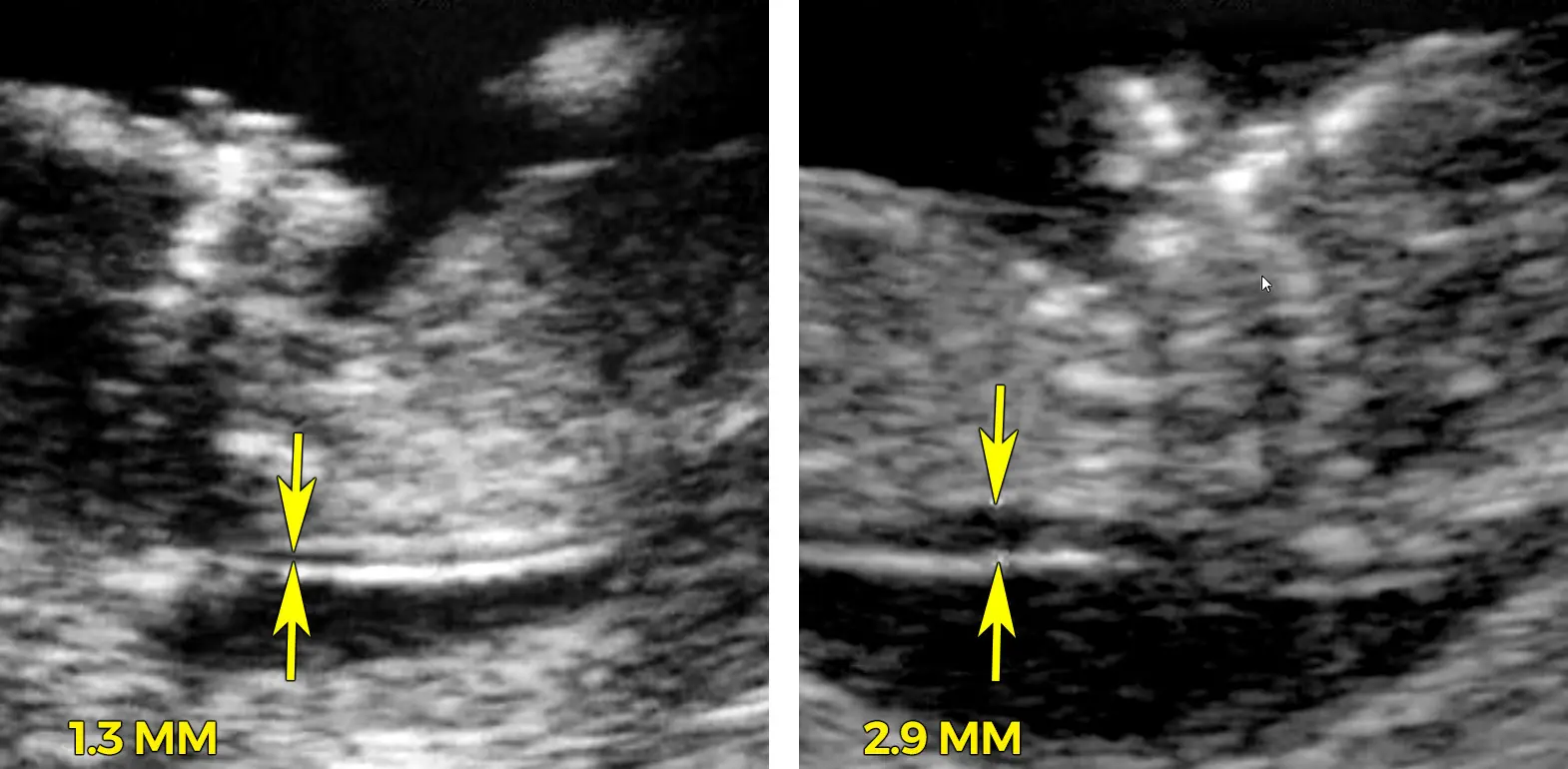 nackenfaltenmessung wann - Wie aussagekräftig ist die Nackenfaltenmessung