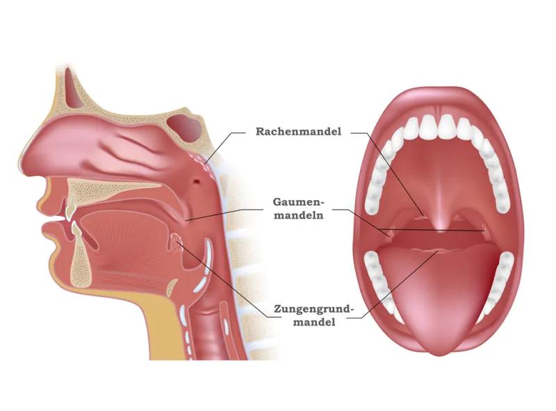 mandelentzündung kleinkind symptome - Wie äußert sich eine Mandelentzündung bei Kleinkindern
