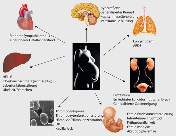 was ist eklampsie - Wie äußert sich Eklampsie
