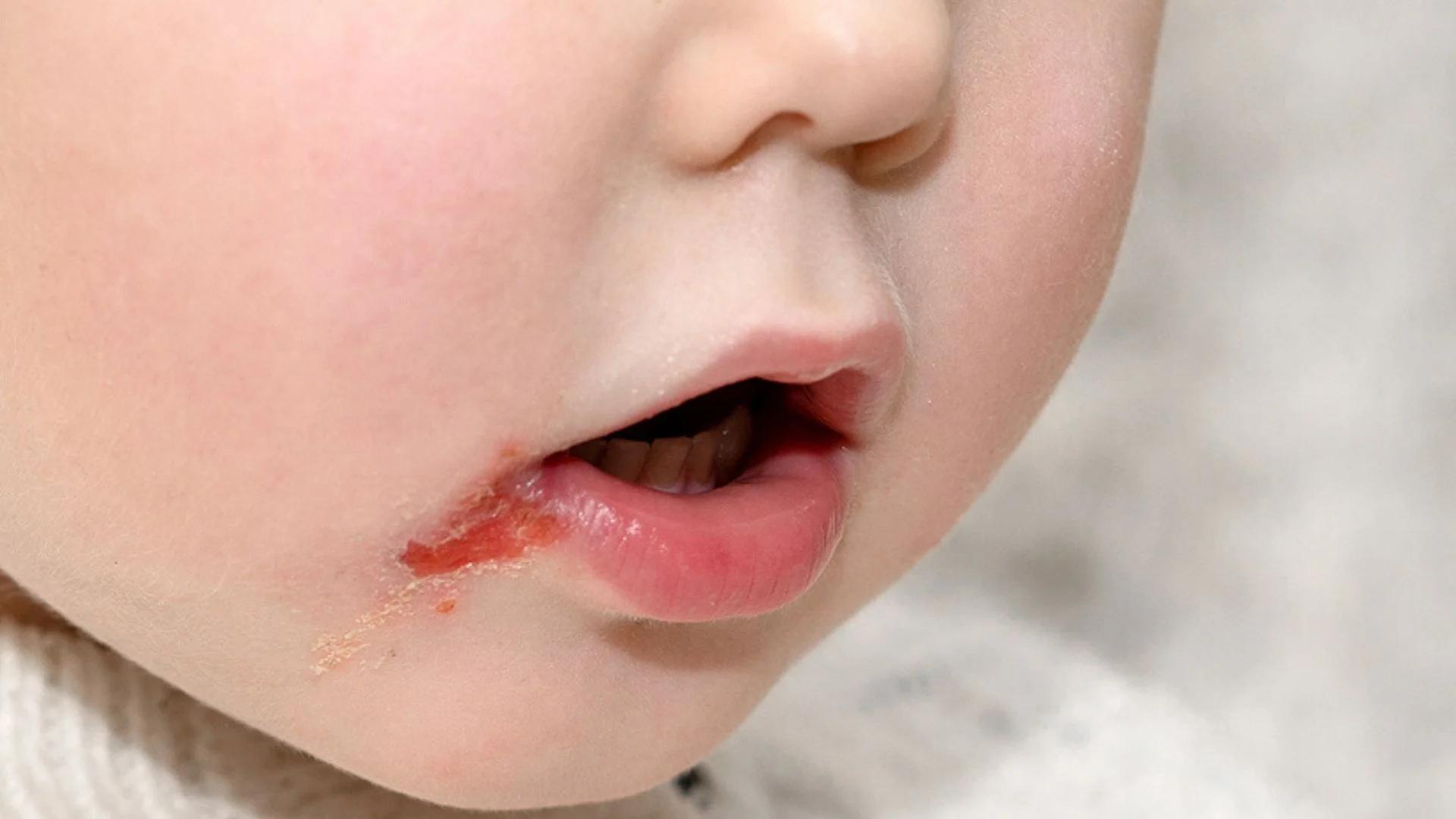 herpes bei säuglingen - Wie äußert sich Herpes-Infektion bei Neugeborenen
