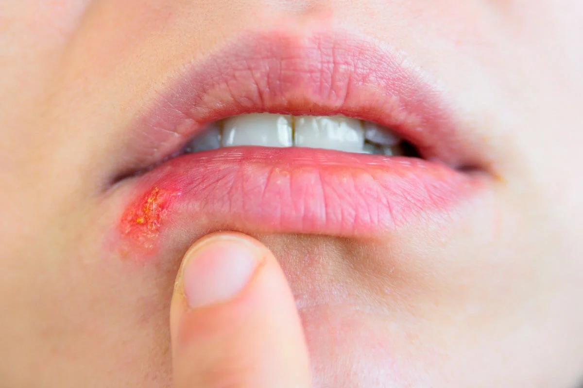 Lippenherpes bei Geburt: Risiken und Schutz für Neugeborene - Wie Baby vor Lippenherpes schützen lippenherpes bei geburt - Wie Baby vor Lippenherpes schützen