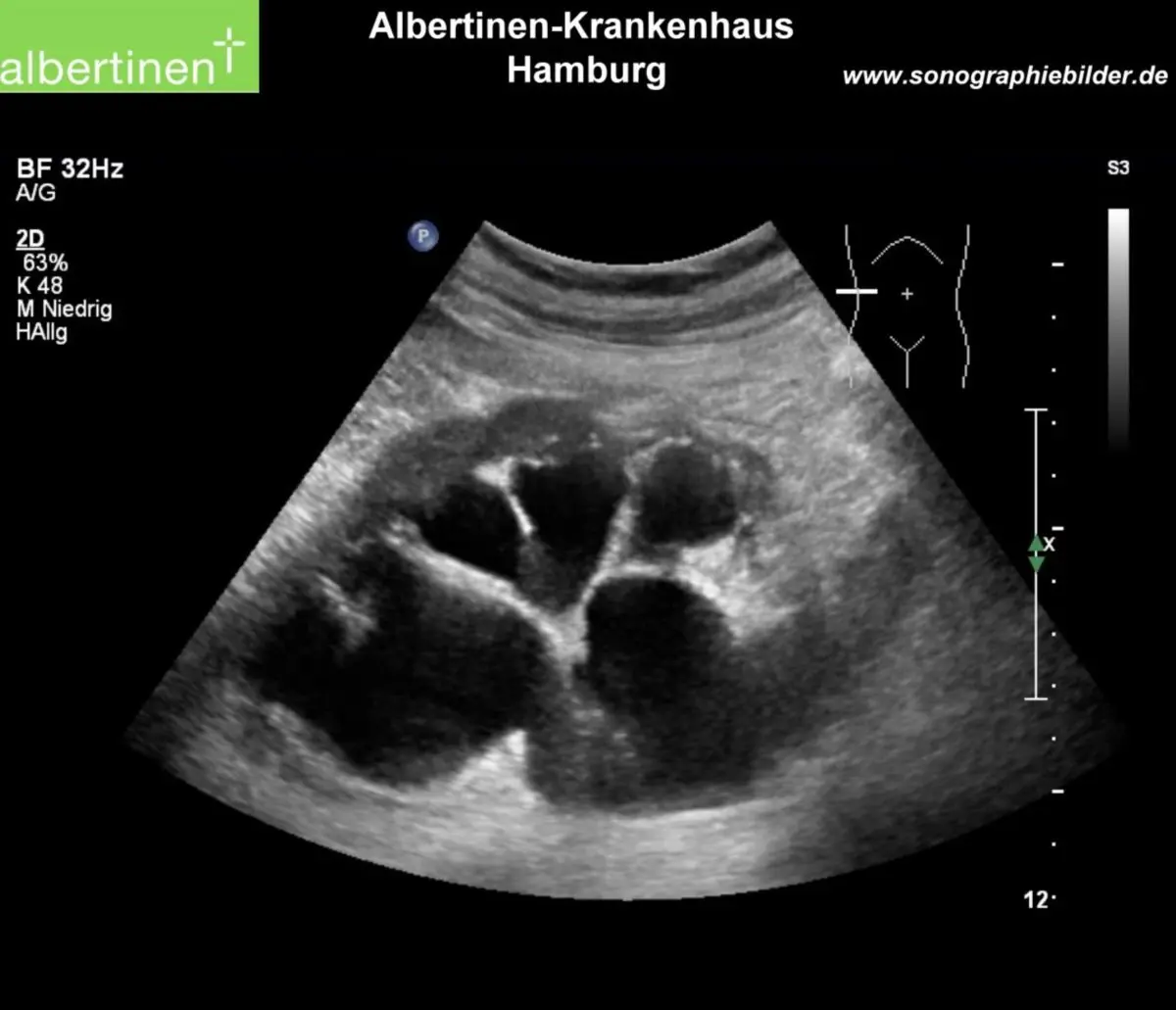 hydronephrose schwangerschaft - Wie behandelt man eine Hydronephrose