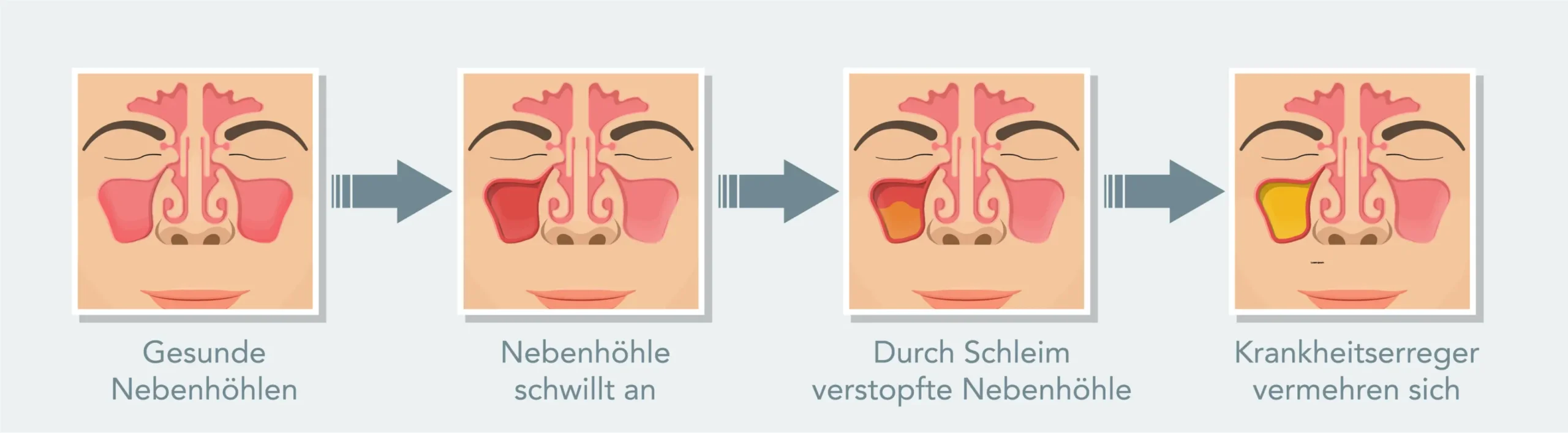 kieferhöhlenentzündung schwangerschaft - Wie bekomme ich den Schleim aus den Kieferhöhlen