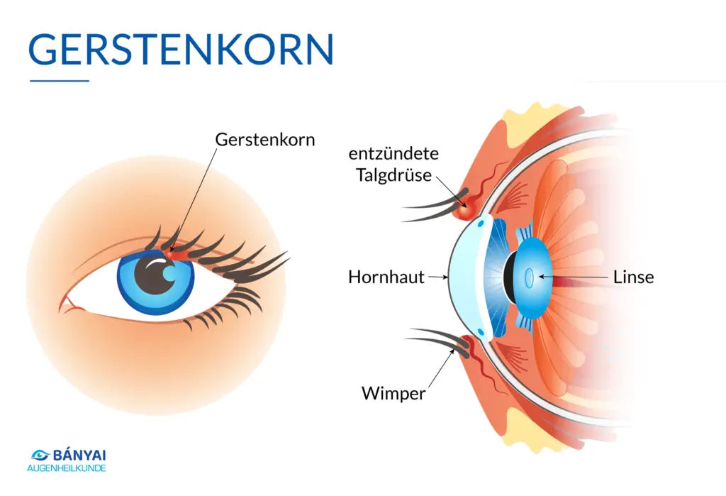 gerstenkorn behandlung - Wie bekomme ich ein Gerstenkorn am Auge schnell weg