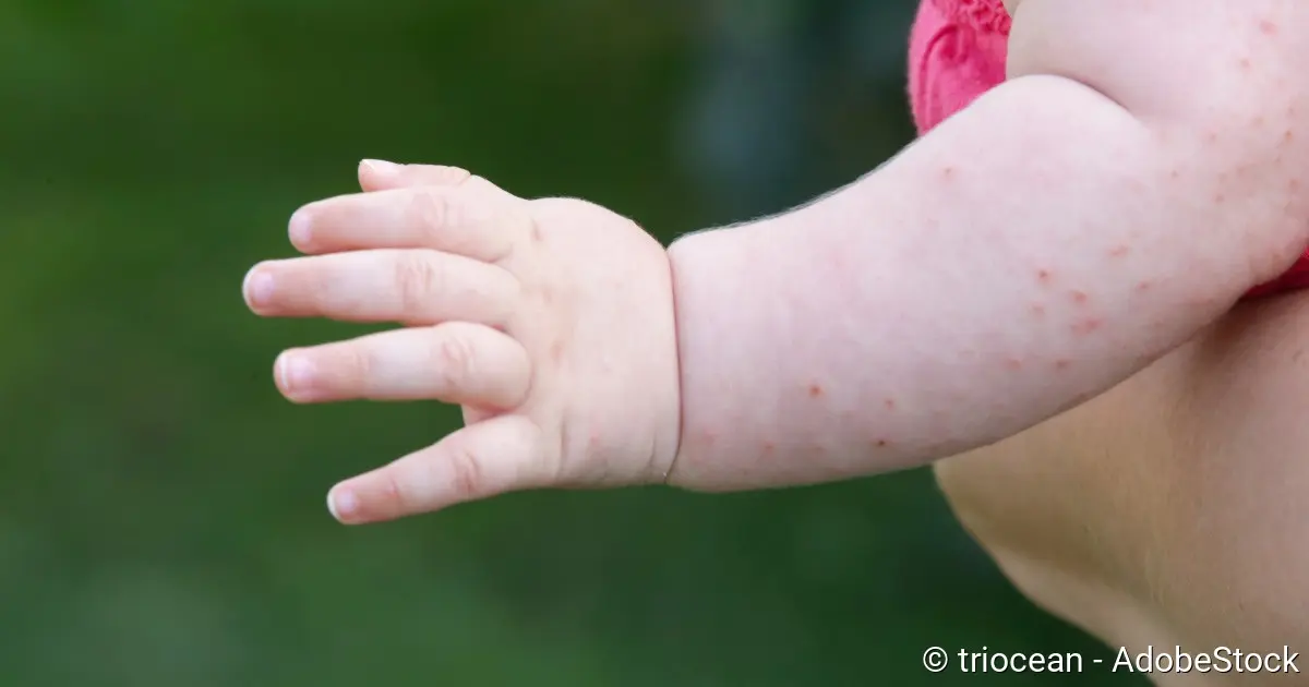 hitzepickel hand - Wie bekomme ich Hitzepickel weg