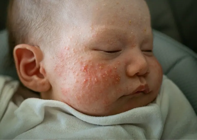 kopfgneis gesicht - Wie bekomme ich Kopfgneis weg