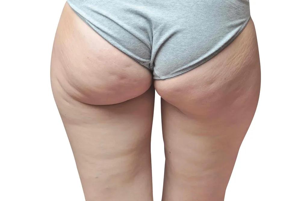 cellulite schwangerschaft - Wie bekomme ich meine Cellulite weg