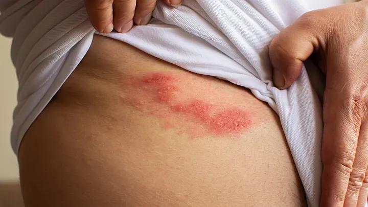 pickeln unter der brust - Wie bekomme ich Pickel unter der Brust weg