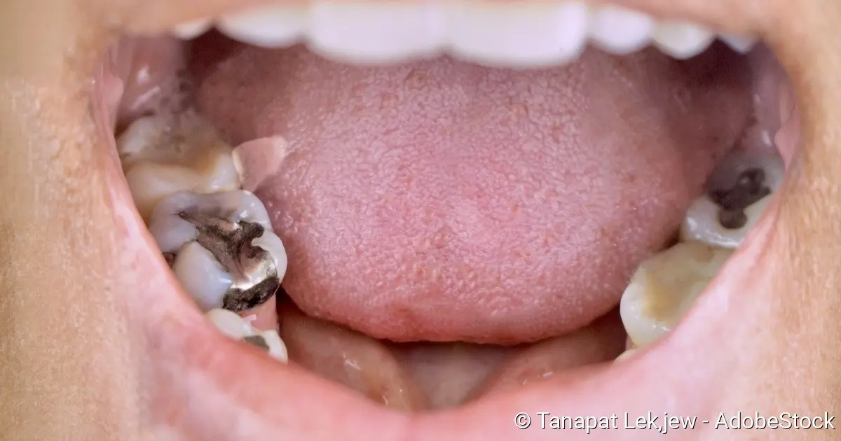 metallvergiftung symptome - Wie bekomme ich Schwermetalle aus dem Körper