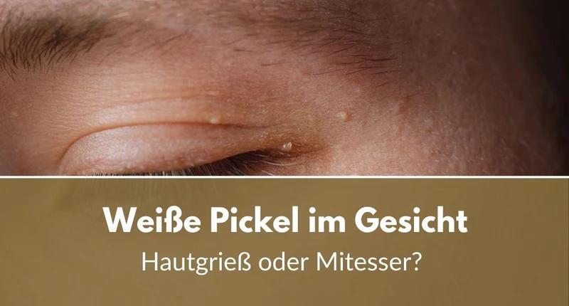 Weiße Pickel: Ursachen, Behandlung und Vorbeugung - Wie bekomme ich weiße Pickel weg weiße pickel - Wie bekomme ich weiße Pickel weg