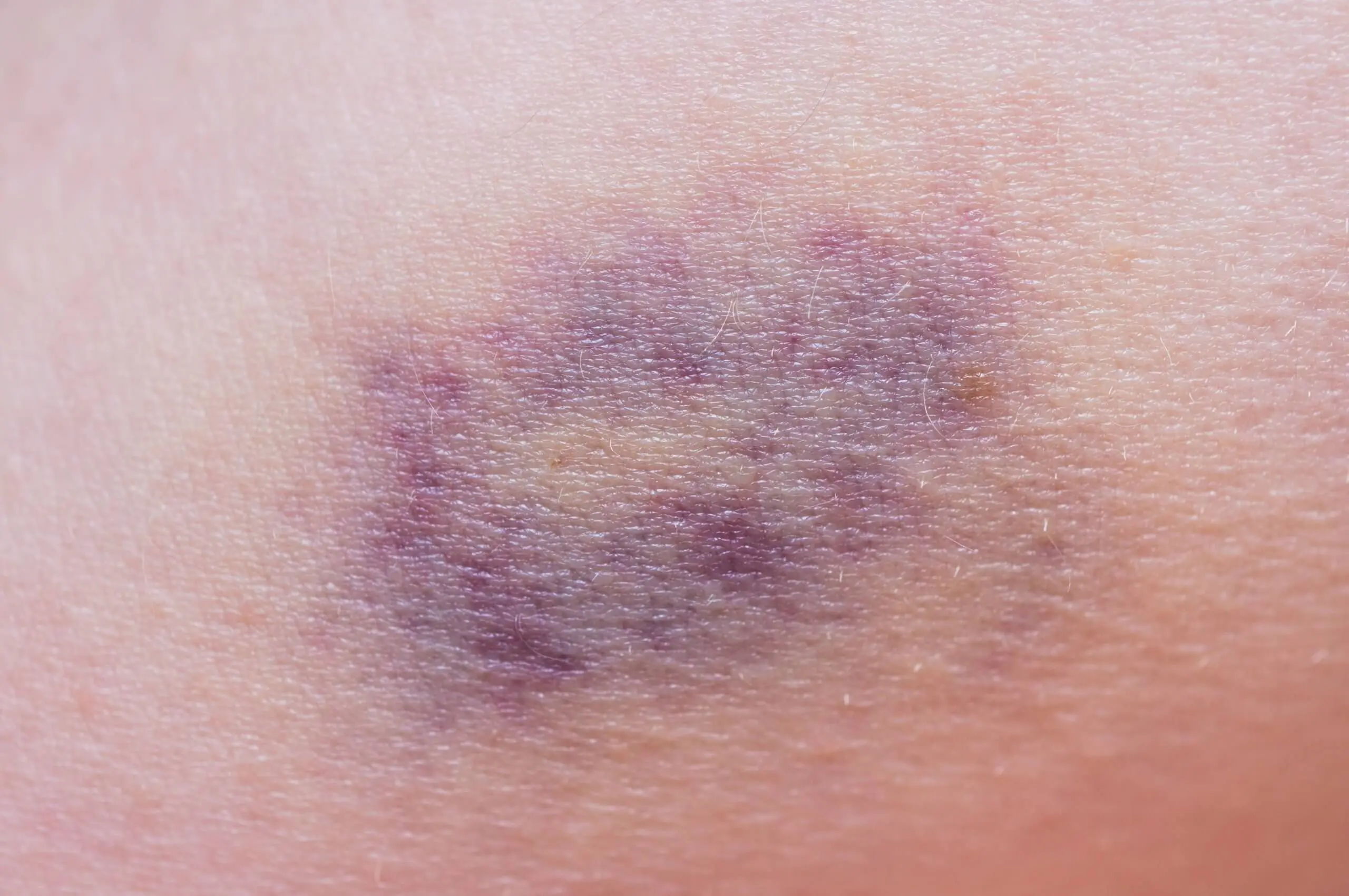 was tun bei blauen flecken - Wie bekommt man blaue Flecken schnell weg