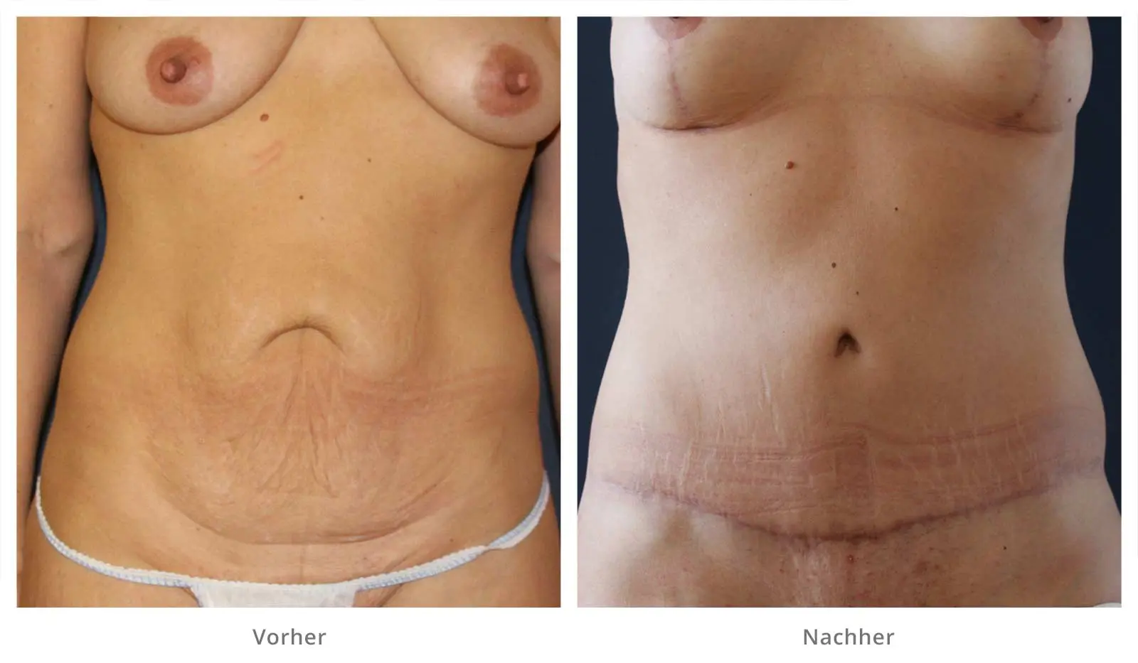 bauchstraffung nach geburt kosten - Wie bekommt man eine Bauchstraffung bezahlt