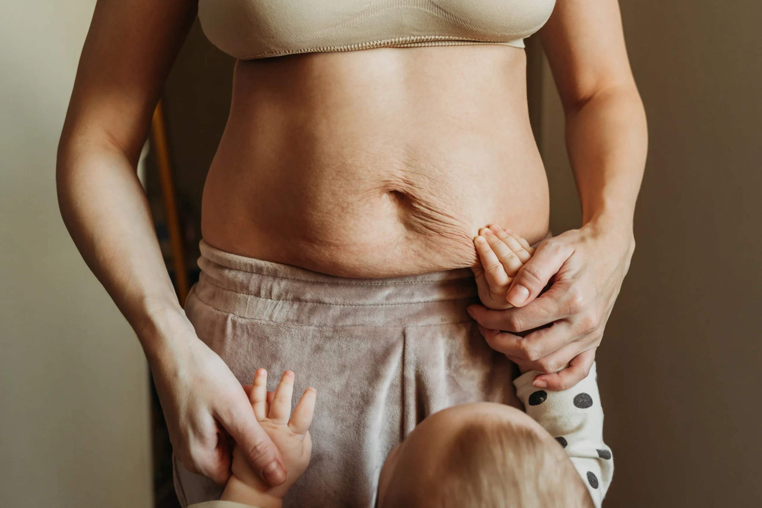 bauchschürze nach geburt - Wie bekommt man Fettschürze am Bauch weg