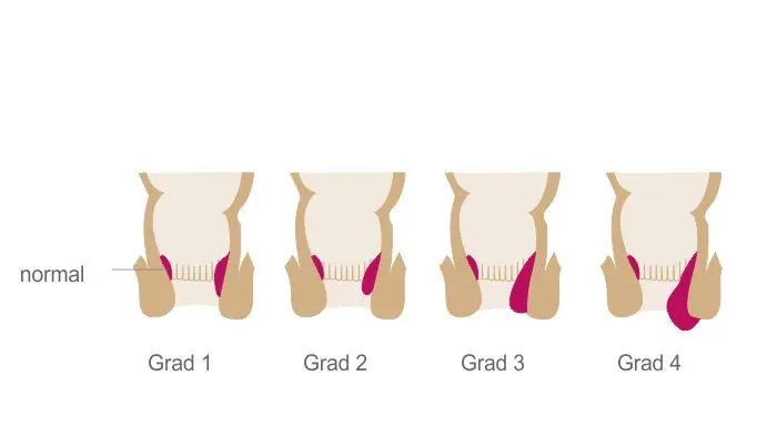 ausstülpung after schwangerschaft - Wie bekommt man Hämorrhoiden Knoten weg