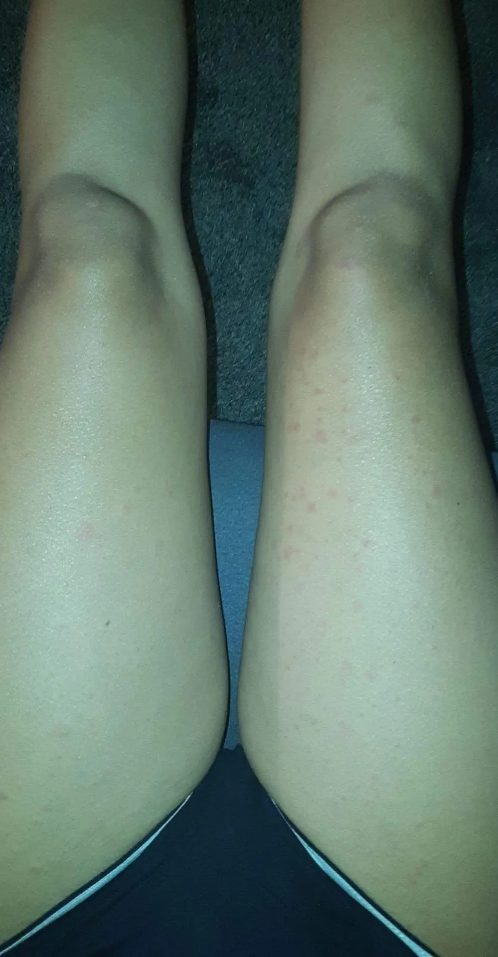 ausschlag innenseite oberschenkel - Wie bekommt man Leistenflechte weg