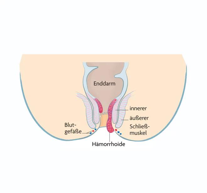 hämorrhoiden nach geburt außen - Wie entfernt man äußere Hämorrhoiden