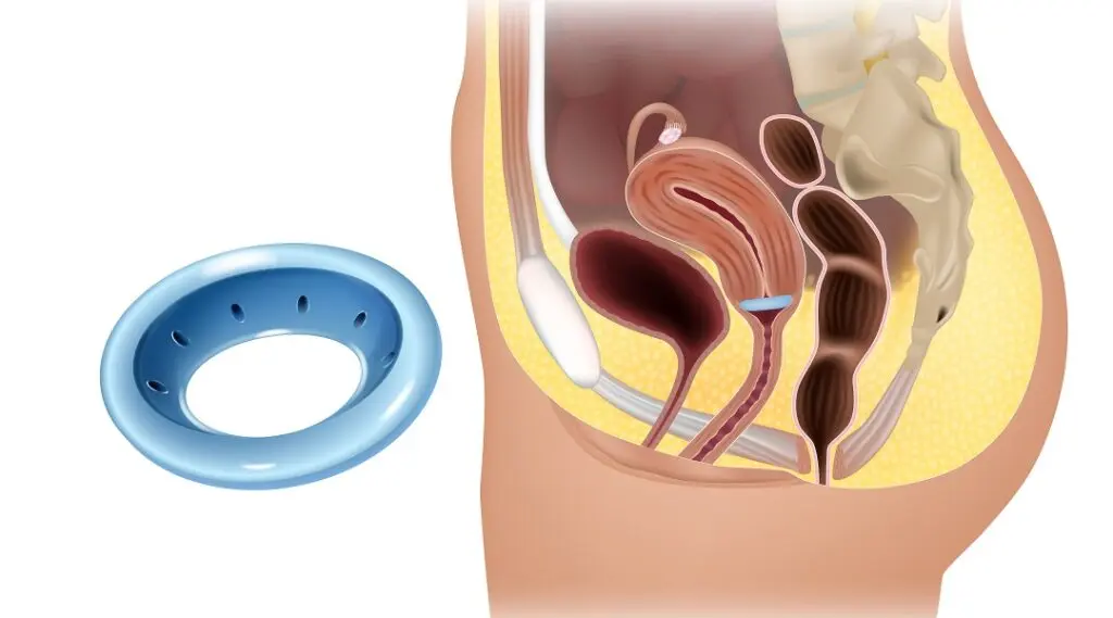 pessar entfernen geburt - Wie entfernt man ein Pessar