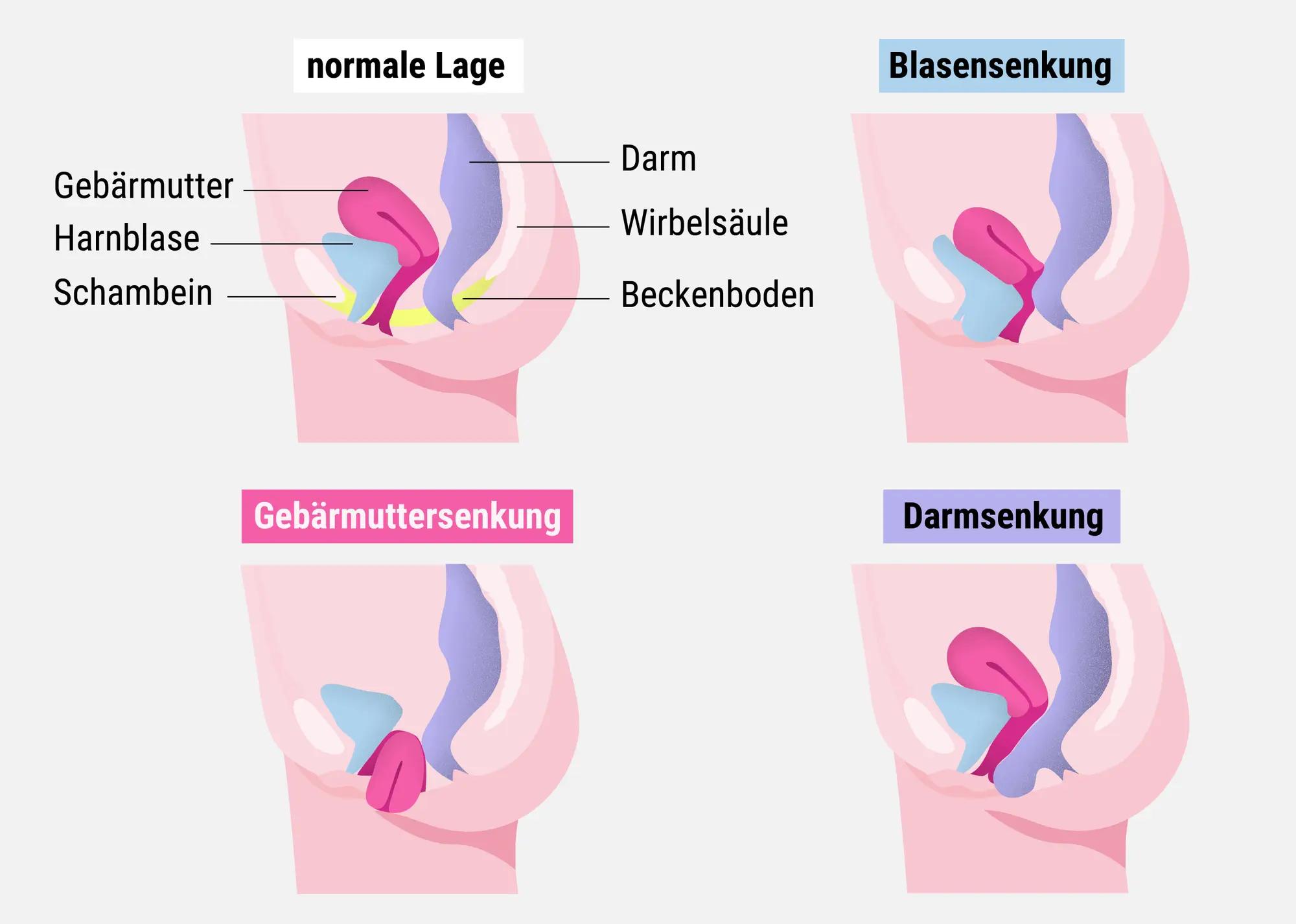 riss in der gebärmutter nach geburt - Wie entsteht Gebärmutterriss