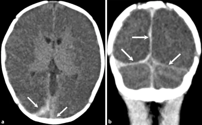 hirnödem nach geburt - Wie entwickelt sich das Gehirn nach der Geburt