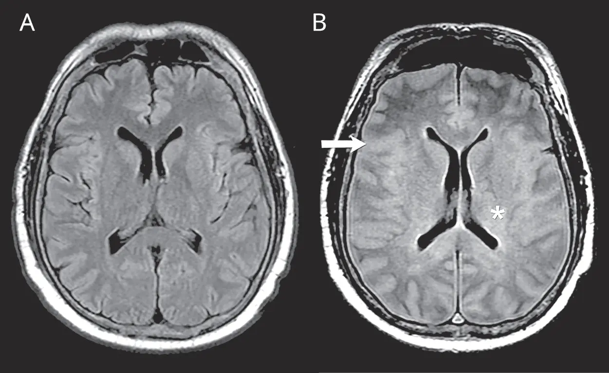 hirnödem nach geburt - Wie entwickelt sich ein Hirnödem