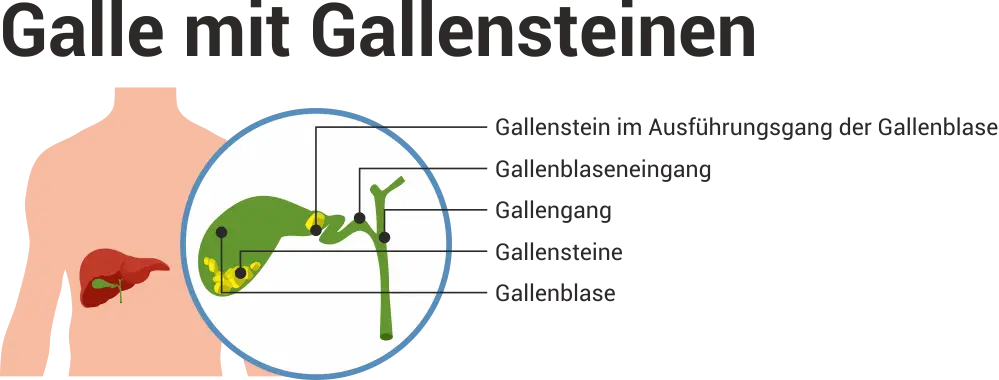 gallenstein bei kindern - Wie erkennt man Gallensteine bei Kindern