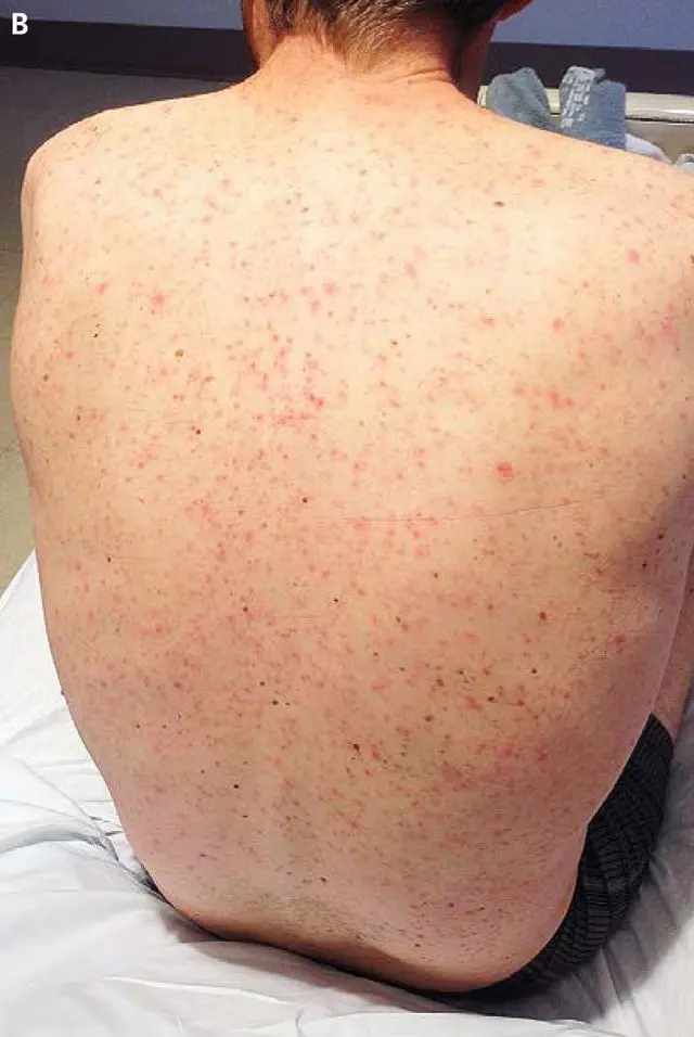 masern symptome bei erwachsenen - Wie erkennt man Masern bei Erwachsenen