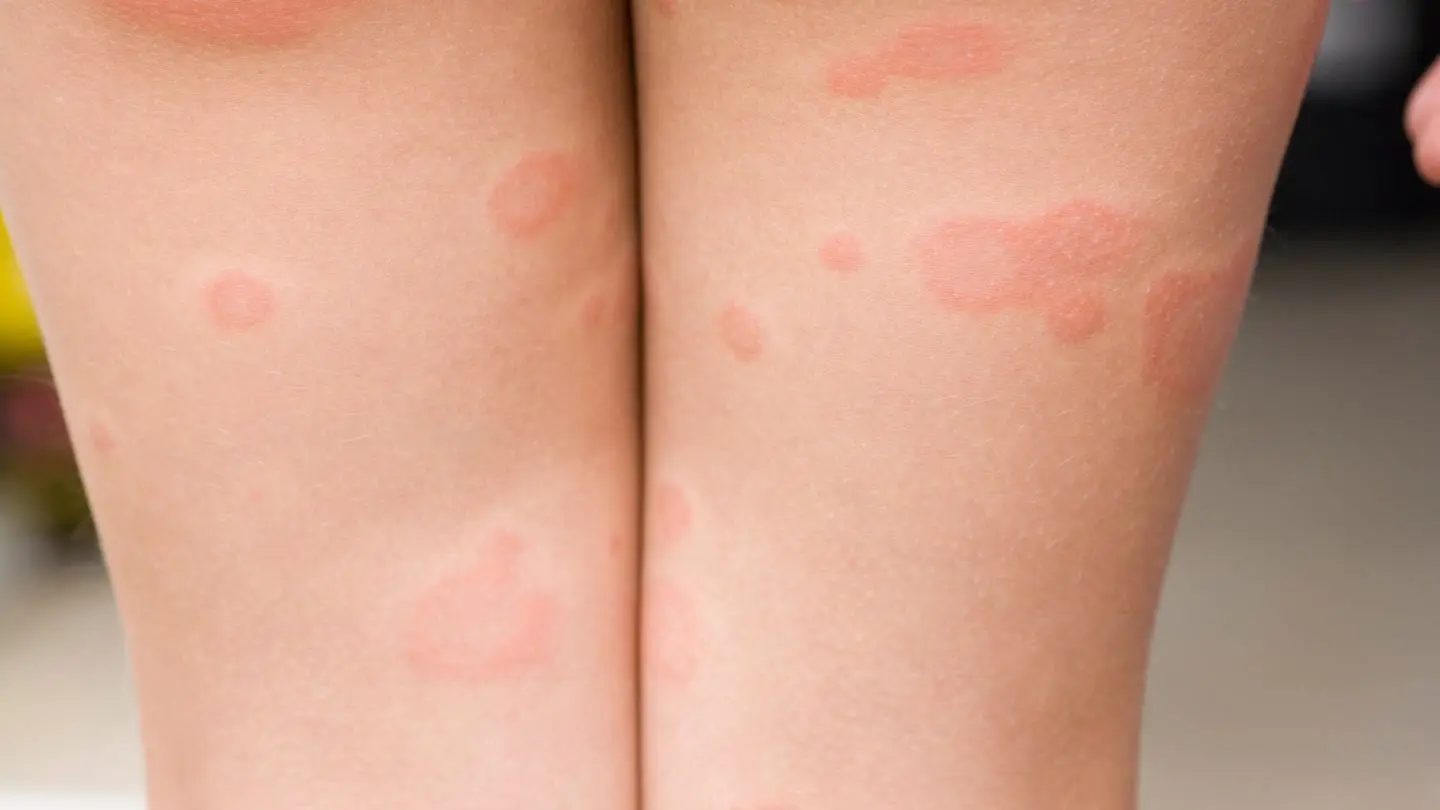 ringelrötel test schwangerschaft - Wie erkennt man Ringelröteln bei Schwangeren