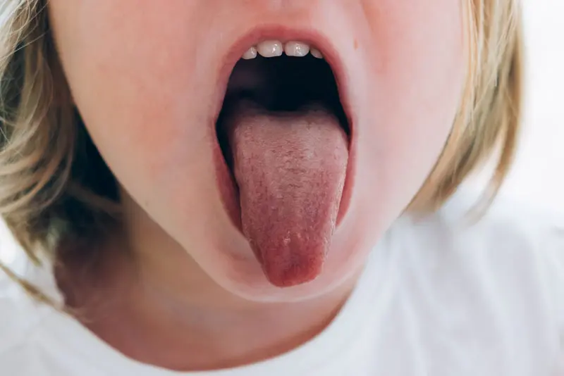 zungenbändchen normal - Wie erkennt man zu kurzes Zungenbändchen Baby