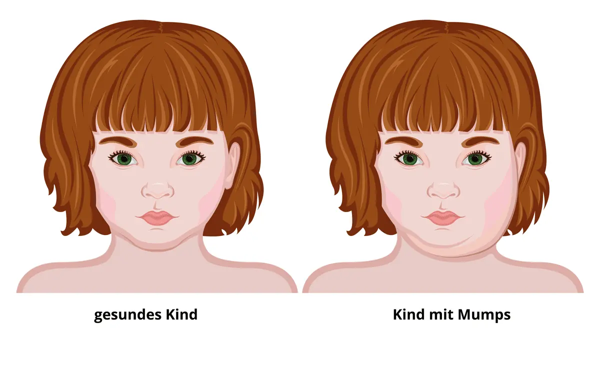 inkubationszeit bei mumps - Wie fängt Mumps an